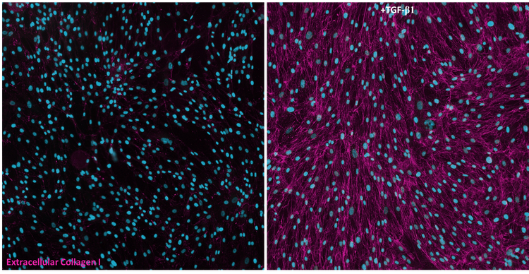 Human lung fibroblasts stimulated with TGF-β1 for 72hours and immunostained