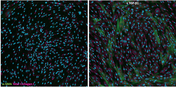 Human lung fibroblasts stimulated with TGF-β1 for 72hours and immunostained