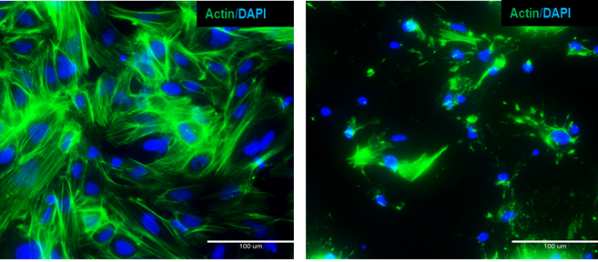 Perturbation du cytosquelette - Hépatocytes dérivés d’iPSC avec marquage de l’actine pour les cellules non traitées et traitées à la latrunculine