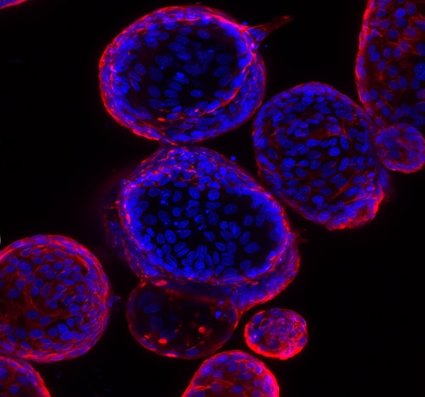 Organoïdes d’adénome duodénal dérivés de tissus de biopsie provenant d’un patient atteint de PAF