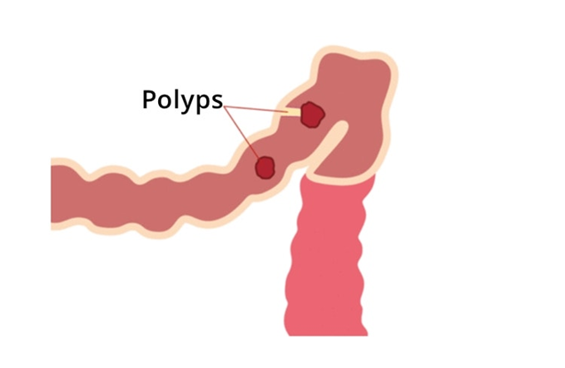 La FAP et la MAP sont des affections héréditaires qui peuvent conduire à la formation de centaines ou de milliers de polypes colorectaux (image de Guts UK Charity)