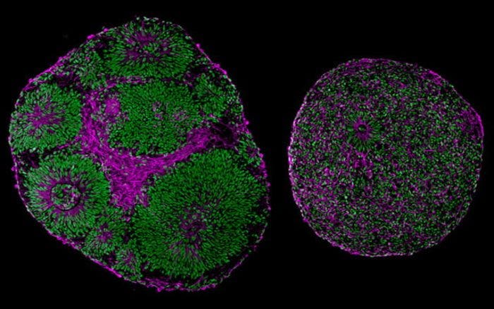 brain organoids derived from a patient with Pitt-Hopkins Syndrome (right) and from a control (left)